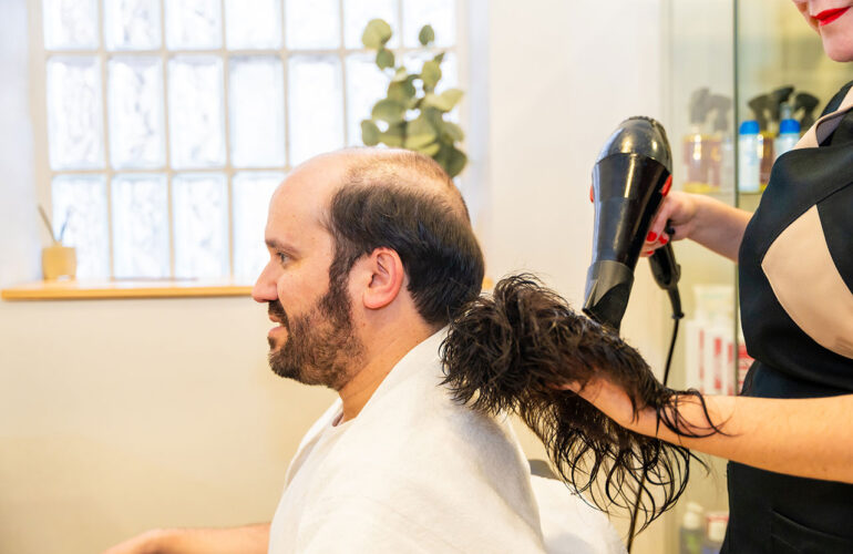 alopecia androgenica