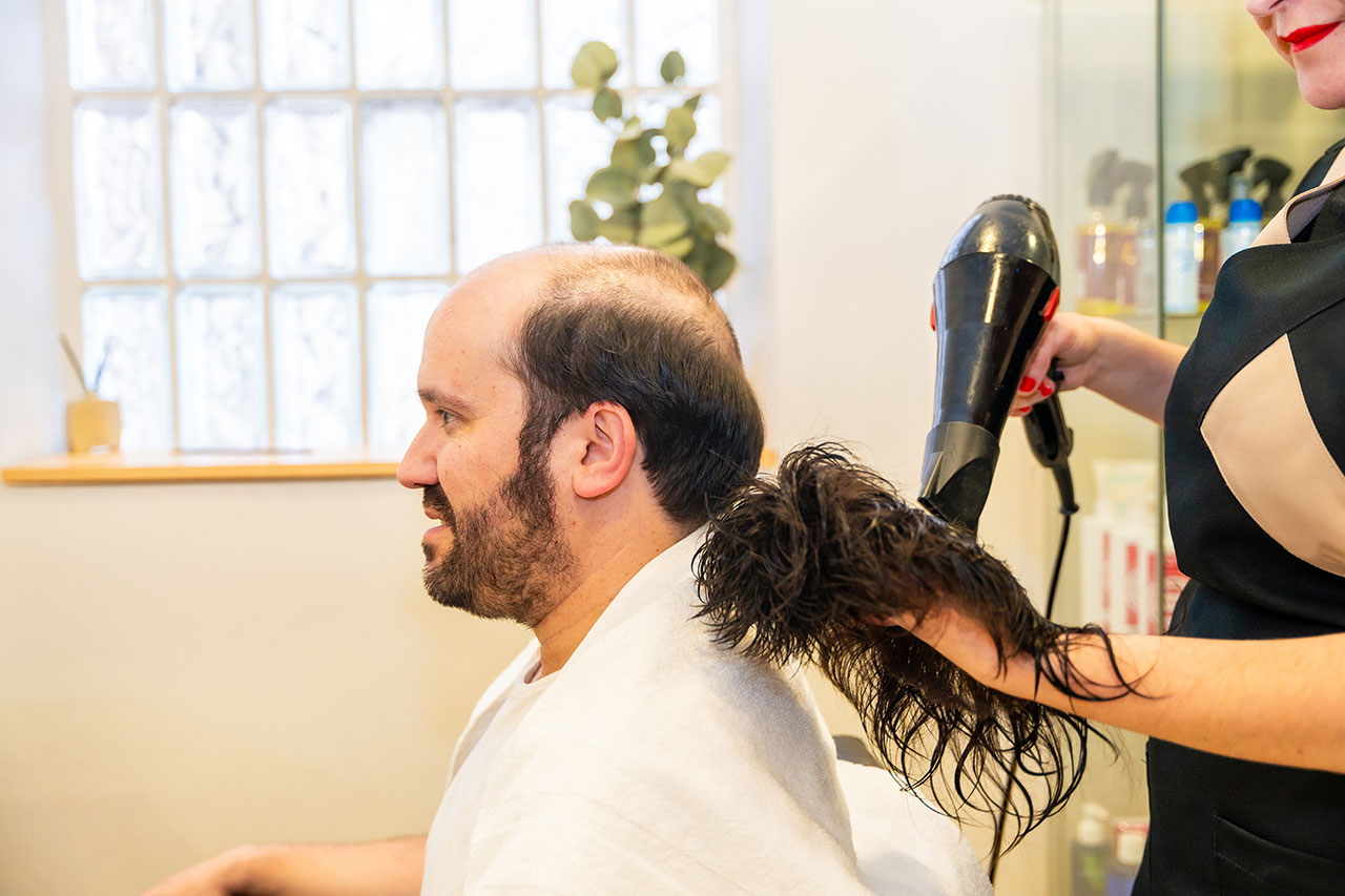 alopecia androgenica