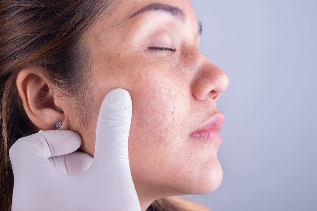 hiperpigmentacion tratamiento hiperpigmentacion tratamiento