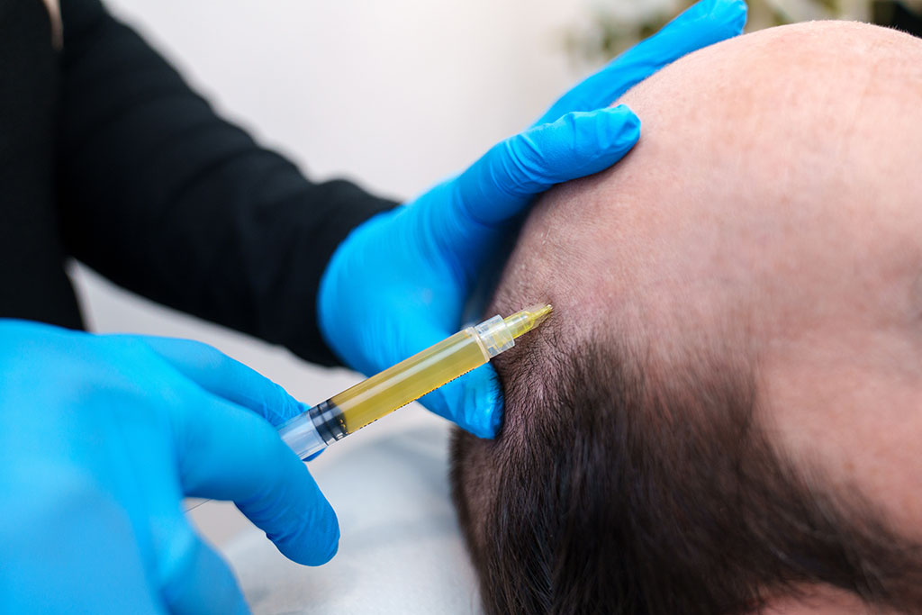 prp y mesoterapia capilar