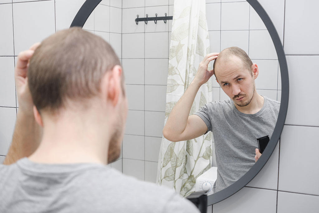 saber si tienes alopecia androgenica