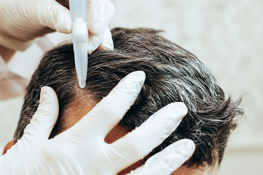 tratamientos efectivos alopecia androgenica