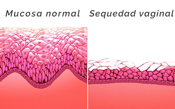 Sequedad Vaginal: Causas y Tratamientos para Recuperar tu Bienestar Íntimo