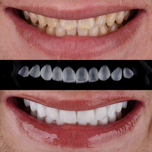 Carillas sin Tallado Dental: La Guía para una Sonrisa Perfecta sin Dañar tus Dientes