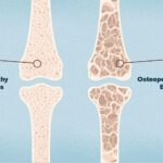 Osteoporosis y Menopausia: Cómo la Terapia Hormonal Puede Proteger tus Huesos