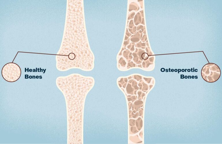 Osteoporosis y Menopausia: Cómo la Terapia Hormonal Puede Proteger tus Huesos