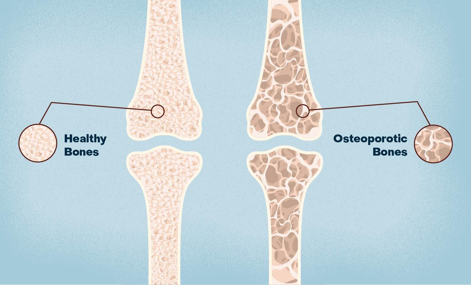 Osteoporosis y Menopausia: Cómo la Terapia Hormonal Puede Proteger tus Huesos