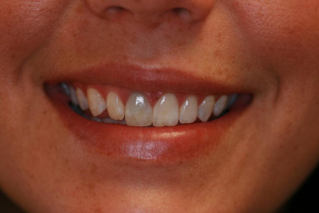 Alternativas complementarias para optimizar el aspecto de tus dientes oscurecidos