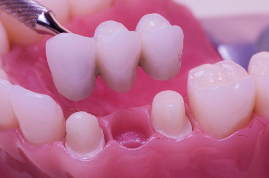 Explora los tipos de puentes dentales para encontrar el que mejor se adapta a ti
