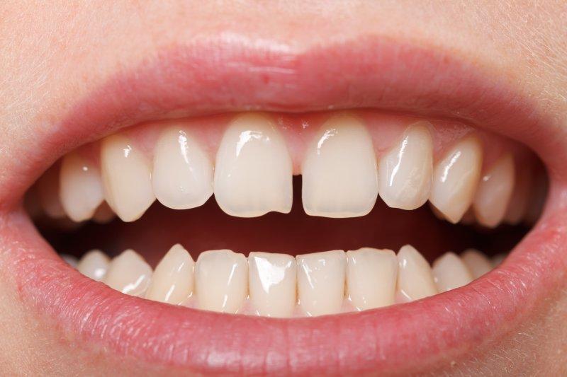 Entendiendo por qué aparecen esos espacios entre tus dientes