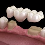 Puentes Dentales: La Guía Definitiva con Tipos, Precios y Cuidados