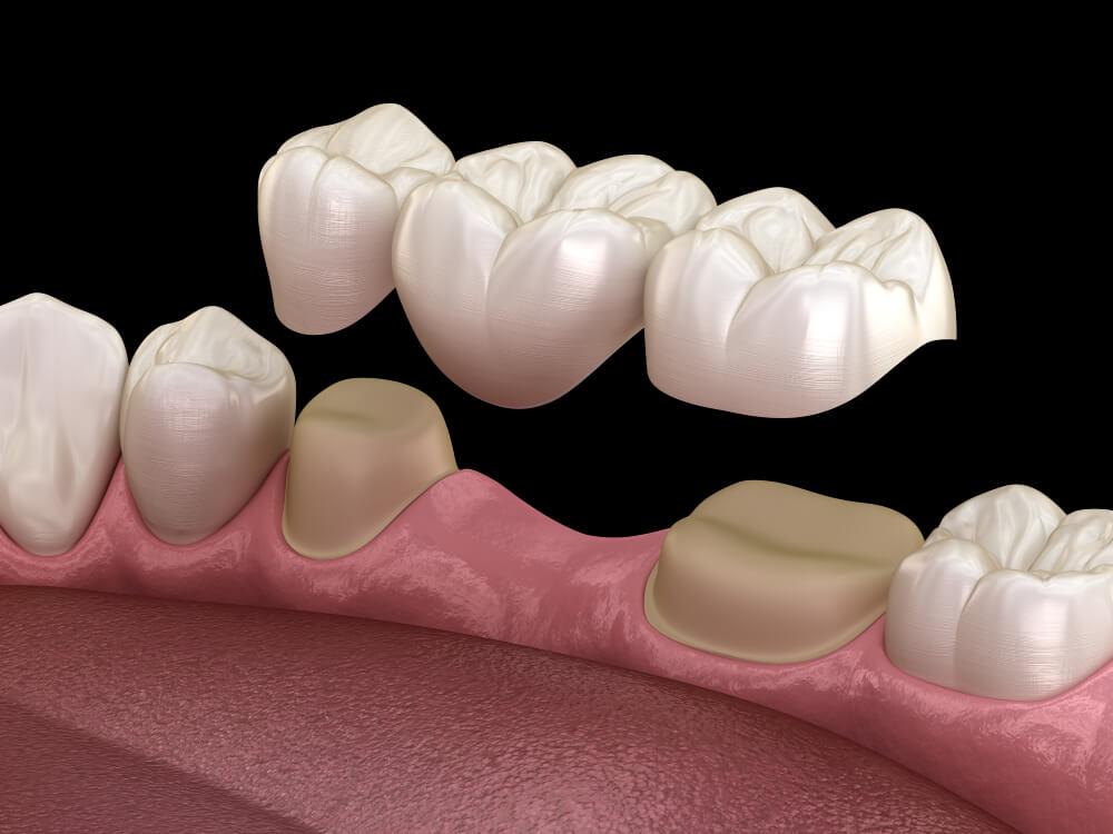 Puentes Dentales: La Guía Definitiva con Tipos, Precios y Cuidados