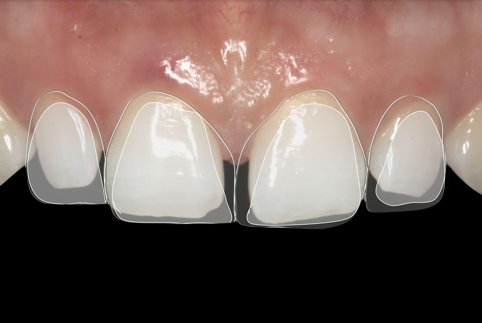 Qué materiales y métodos ofrecen resultados naturales y duraderos para ti
