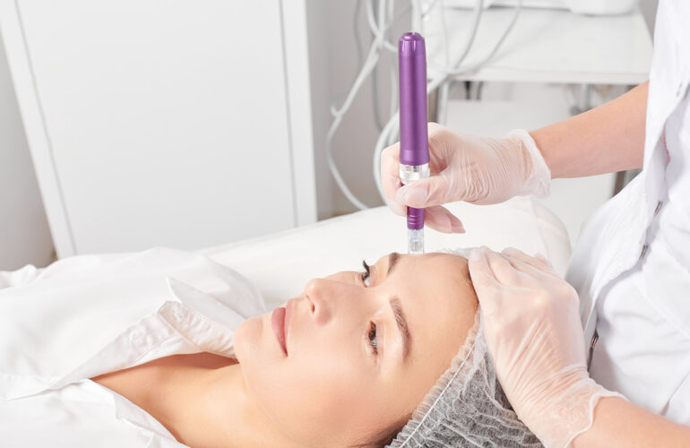 microneedling