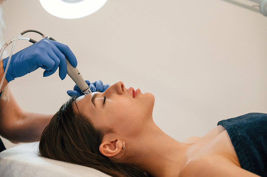 microneedling como funciona