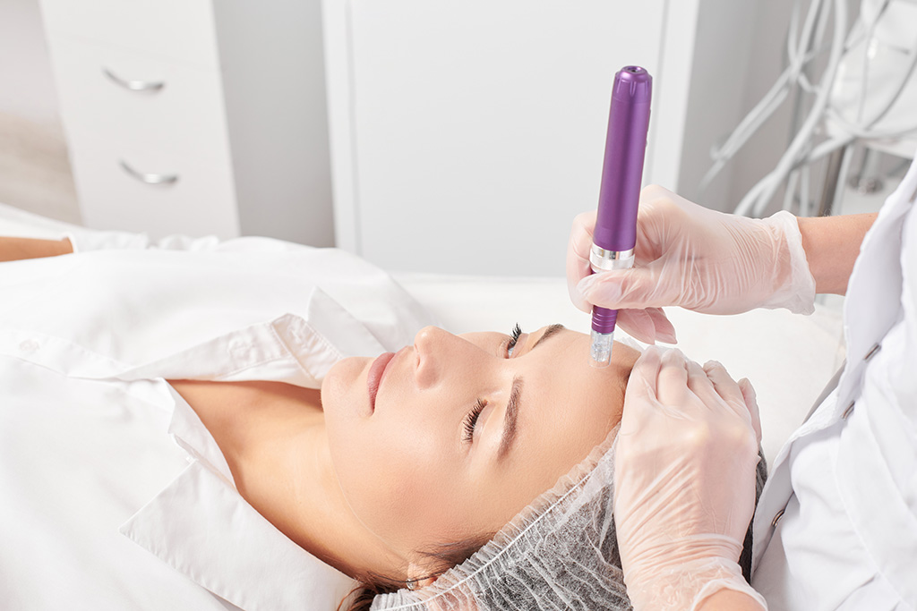 microneedling precio