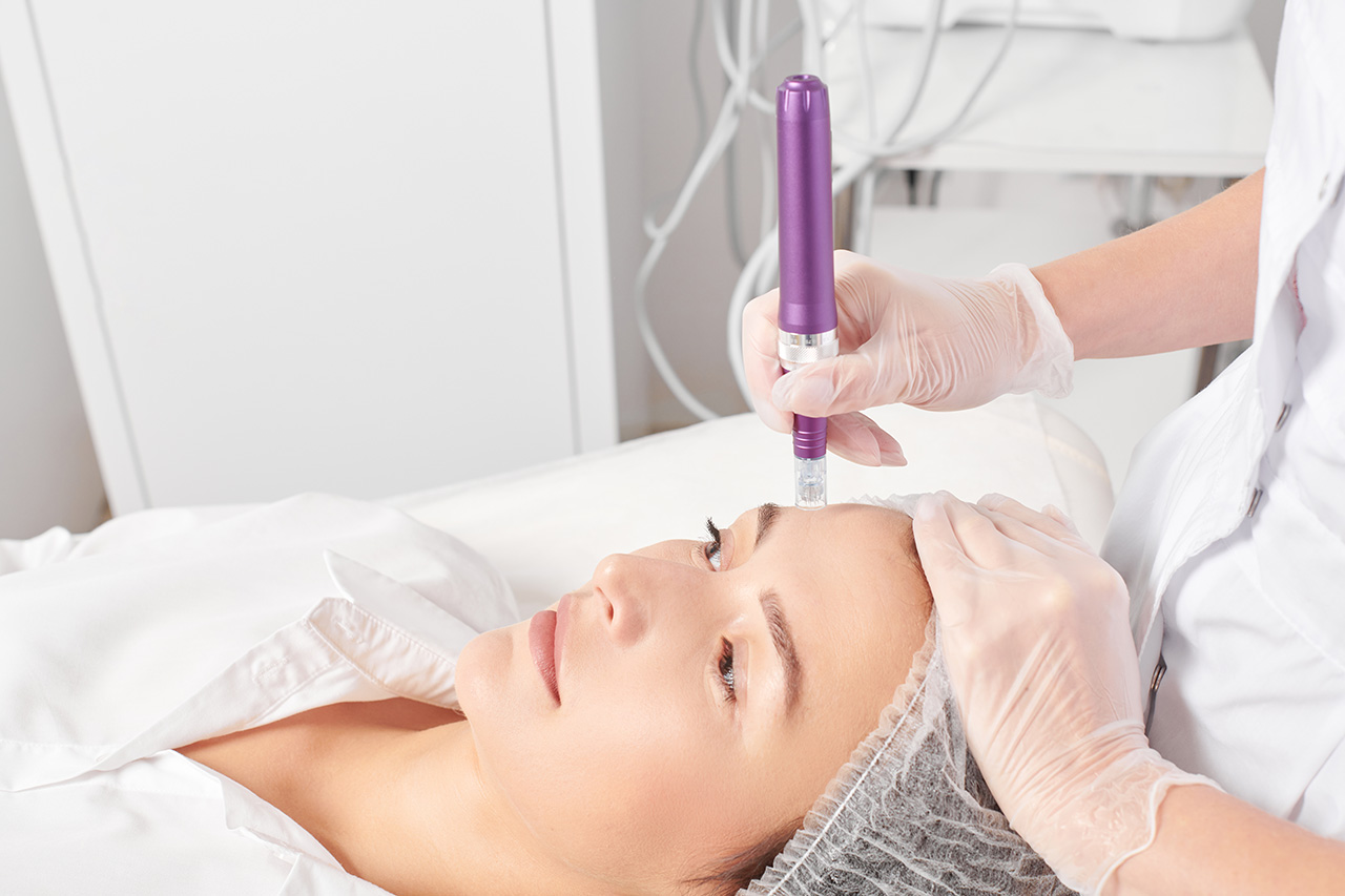 microneedling