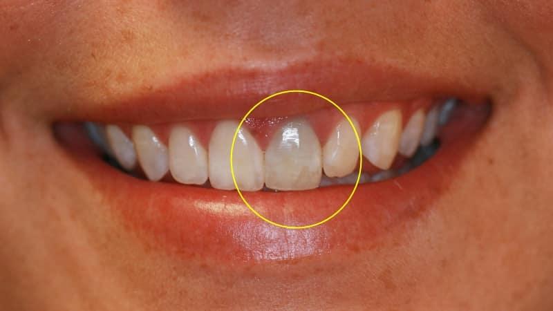 Qué es el blanqueamiento dental interno y por qué es clave tras una endodoncia