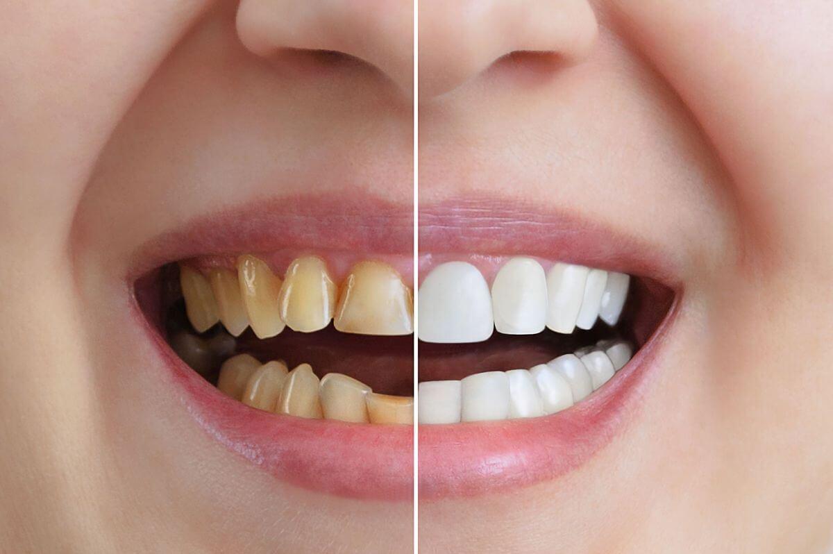 Cómo funcionan las carillas sin tallado para transformar tu sonrisa sin dolor