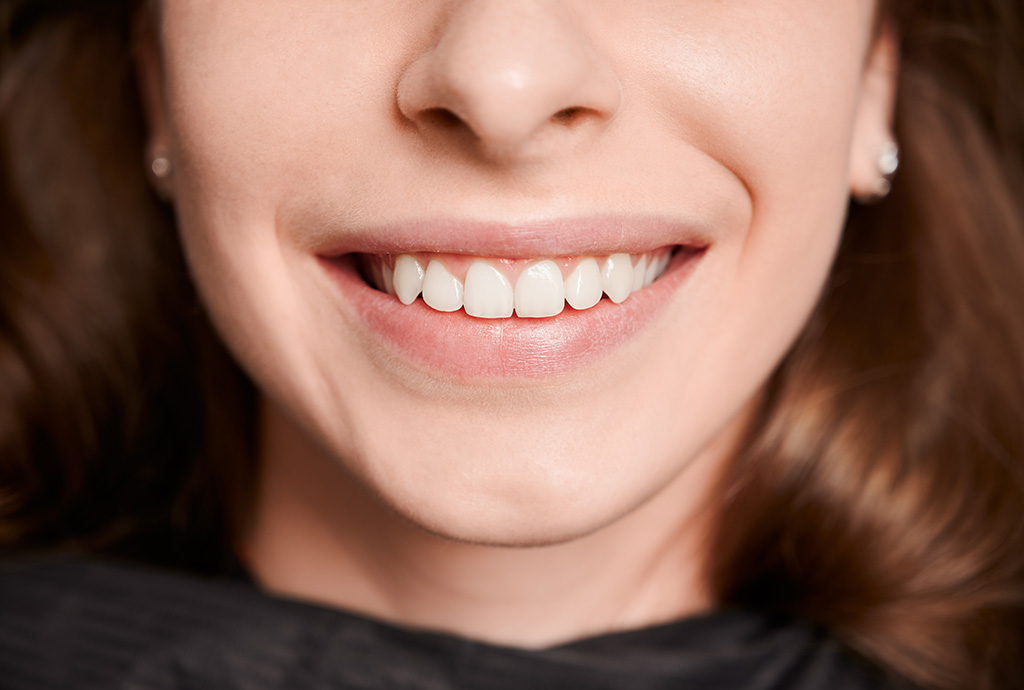 resultados restauracion dental