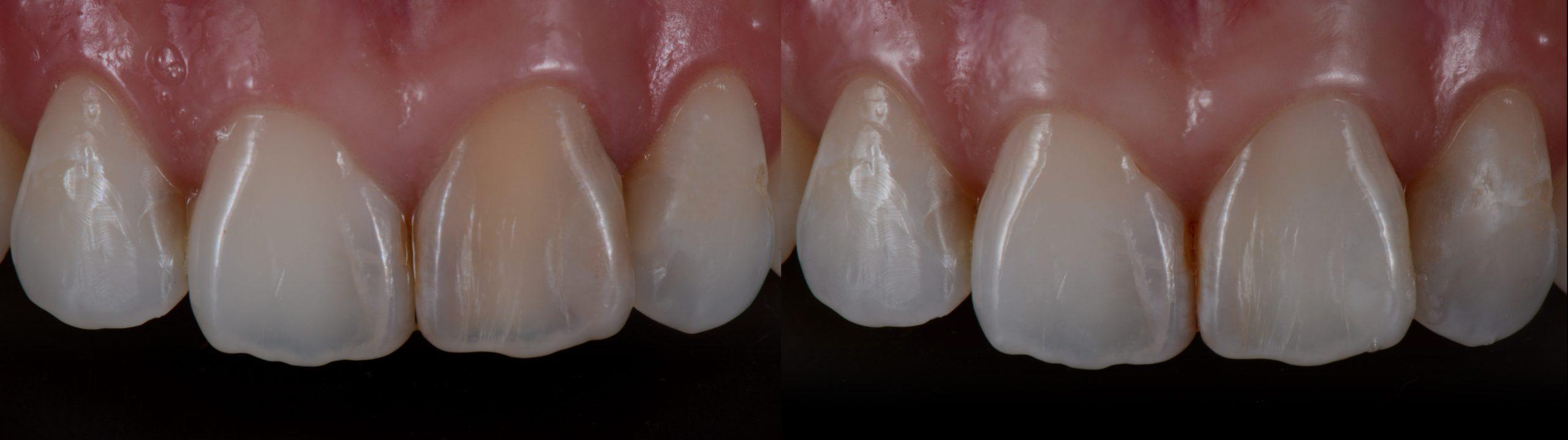Lo que debes saber sobre el cuidado y mantenimiento después de un blanqueamiento dental interno