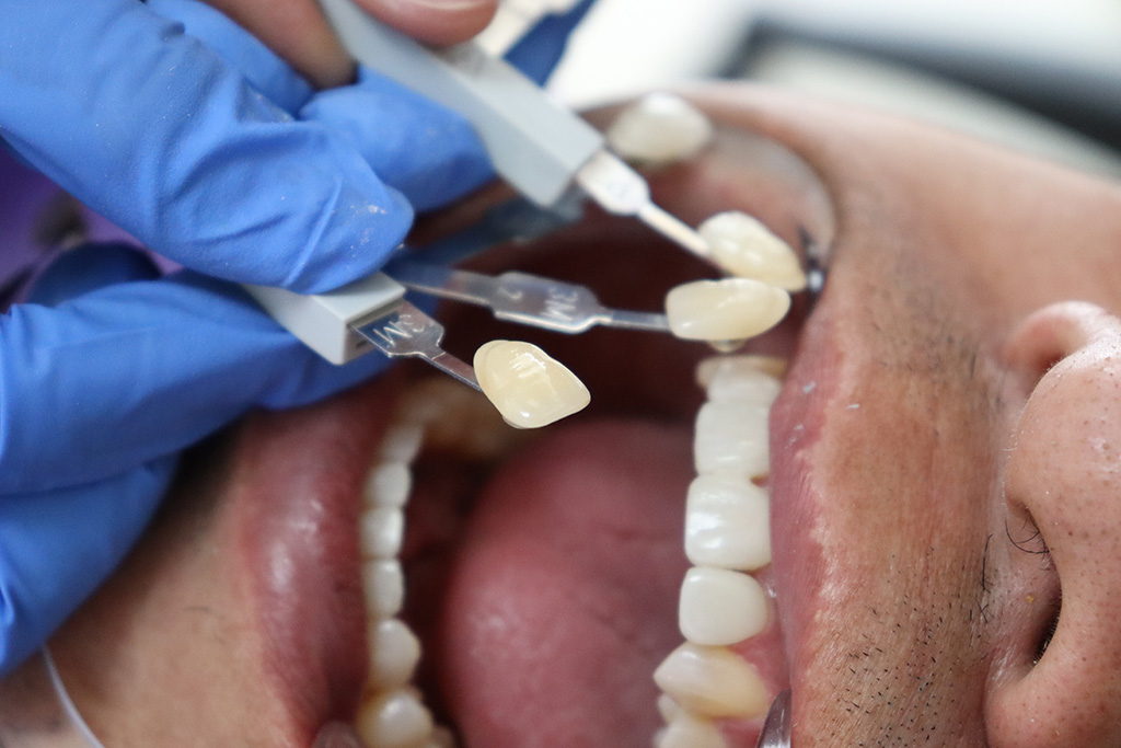 tipos de coronas dentales