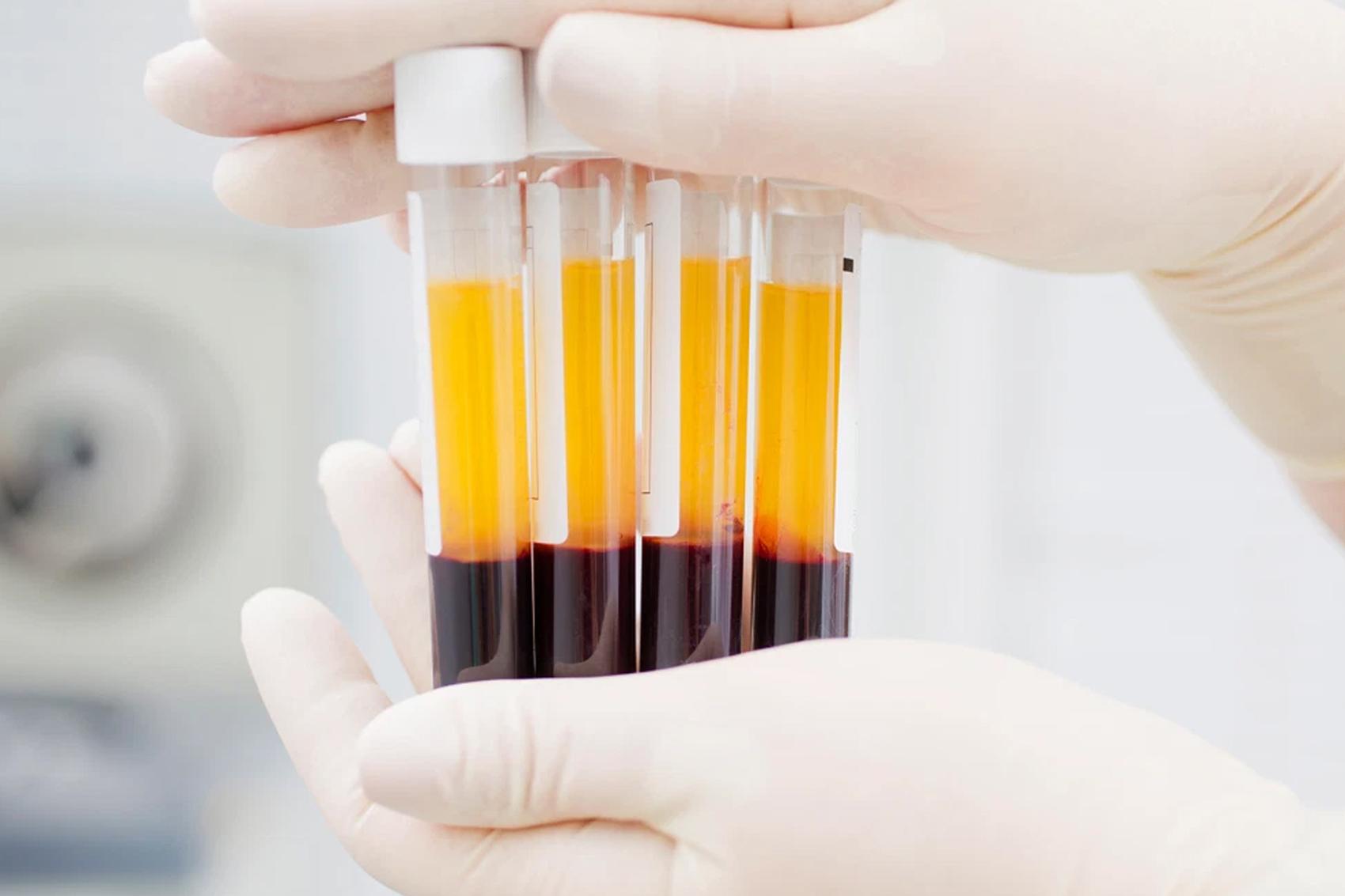 Descubre qué es el Plasma Rico en Plaquetas y cómo funciona dentro de tu cuerpo