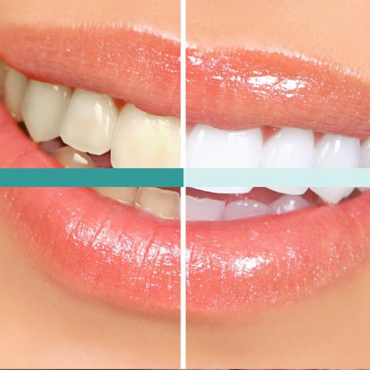 Entiende cómo influye tu tono natural de dientes en la elección del color ideal