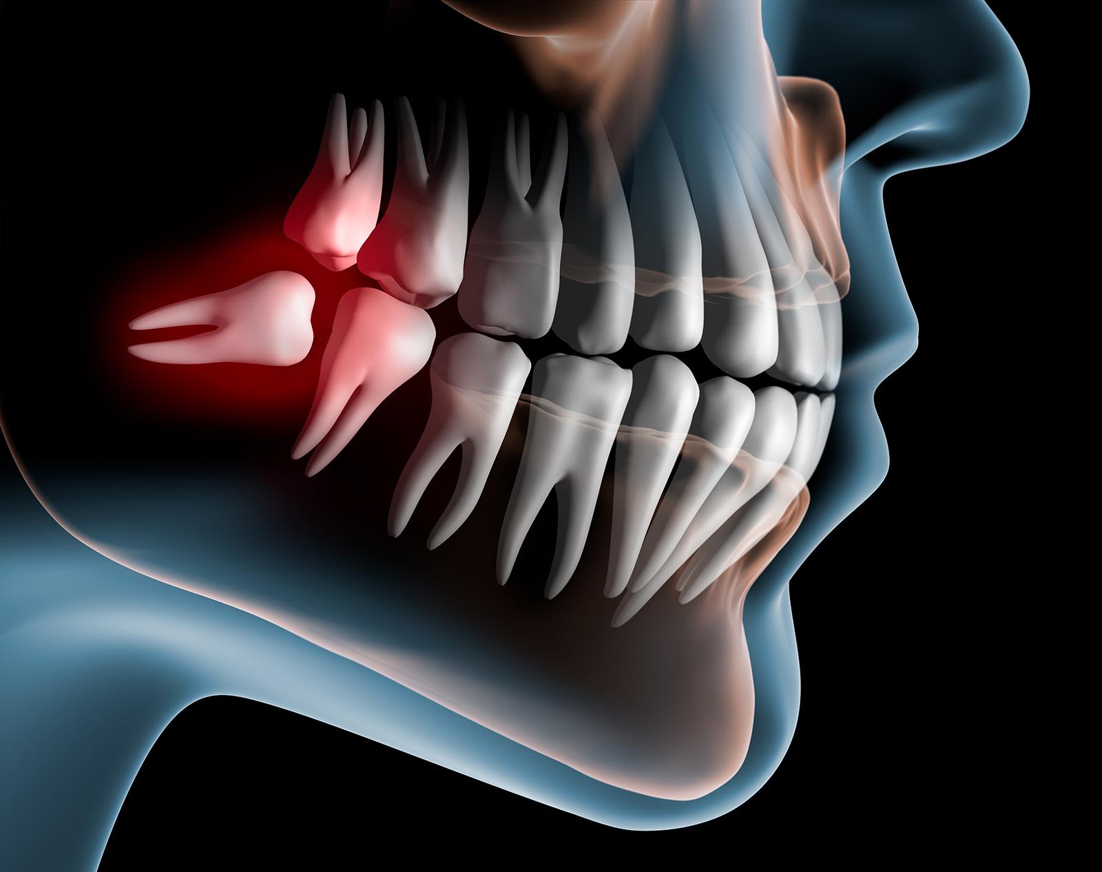 Entendiendo la función y el impacto de las muelas del juicio en tu salud dental