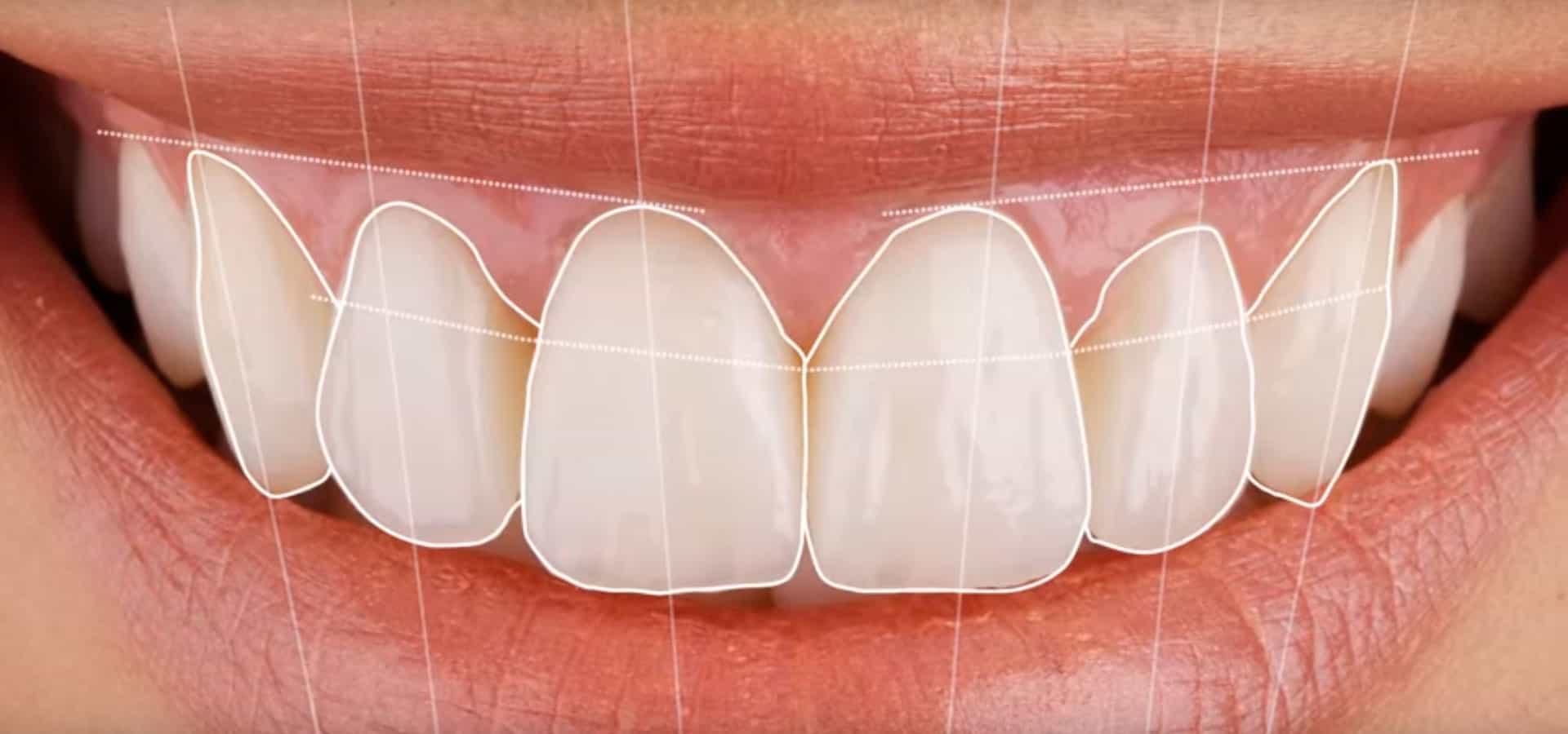 Descubre qué es el Diseño de Sonrisa Digital y cómo transforma tu experiencia dental
