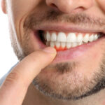 Injerto de Encía: Mejora la Estética de tu Sonrisa y Cubre las Raíces Expuestas