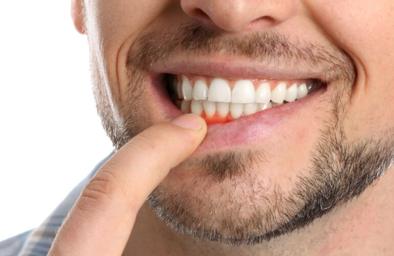 Injerto de Encía: Mejora la Estética de tu Sonrisa y Cubre las Raíces Expuestas