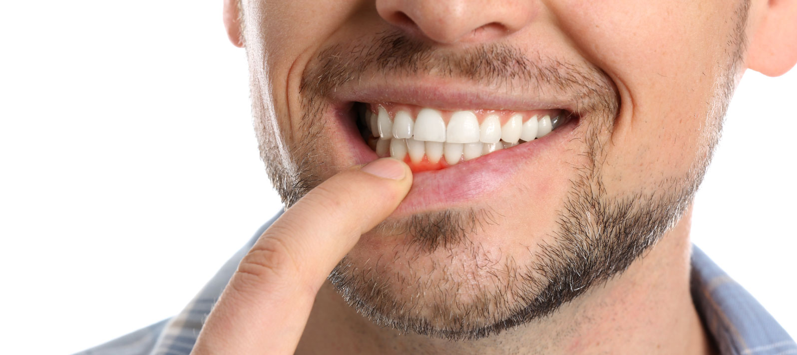 Injerto de Encía: Mejora la Estética de tu Sonrisa y Cubre las Raíces Expuestas