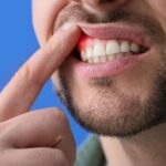 Recesión de Encías: Causas, Síntomas y Tratamientos para Recuperarlas