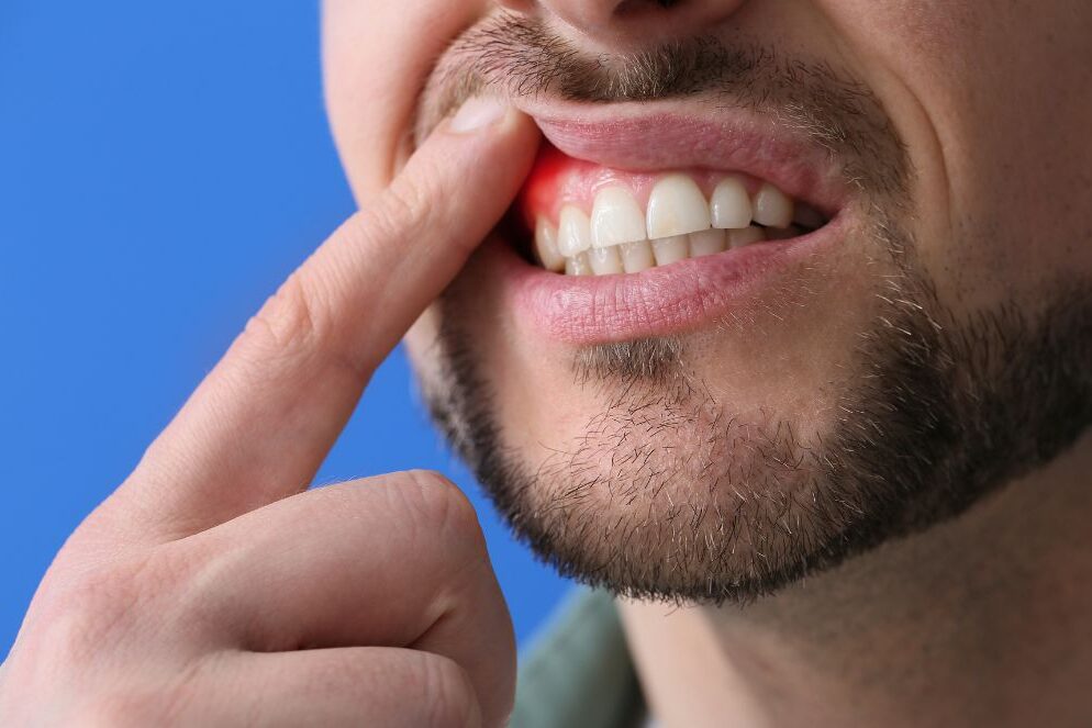 Recesión de Encías: Causas, Síntomas y Tratamientos para Recuperarlas