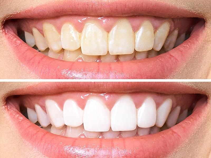 Cómo evaluar junto con tu especialista las necesidades específicas de tu sonrisa