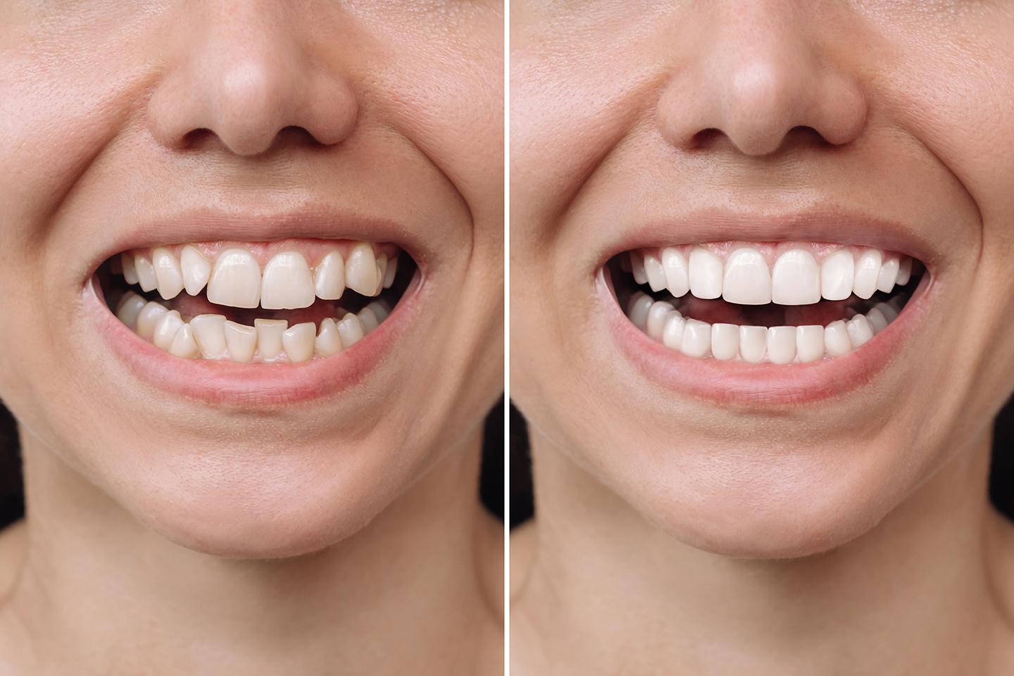 Descubre cómo combinar tus carillas y coronas con el resto de tu sonrisa para un look armonioso