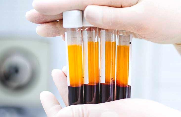 Conoce cómo el PRP potencia la regeneración capilar y combate la caída del cabello