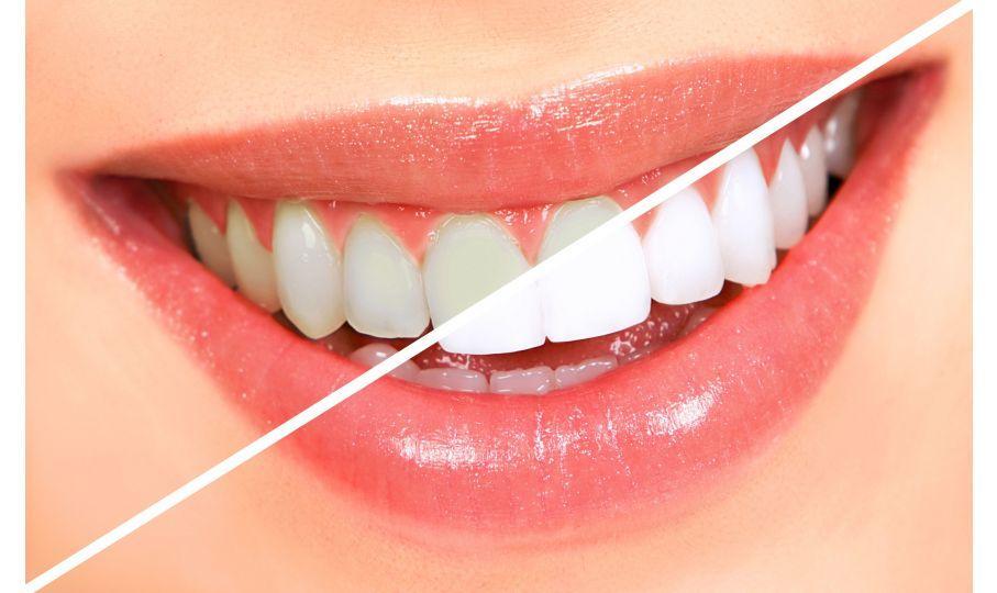 como mantener tu blanqueamiento dental consejos para una sonrisa blanca por mas tiempo.jpg Cómo Mantener tu Blanqueamiento Dental: Consejos para una Sonrisa Blanca por Más Tiempo