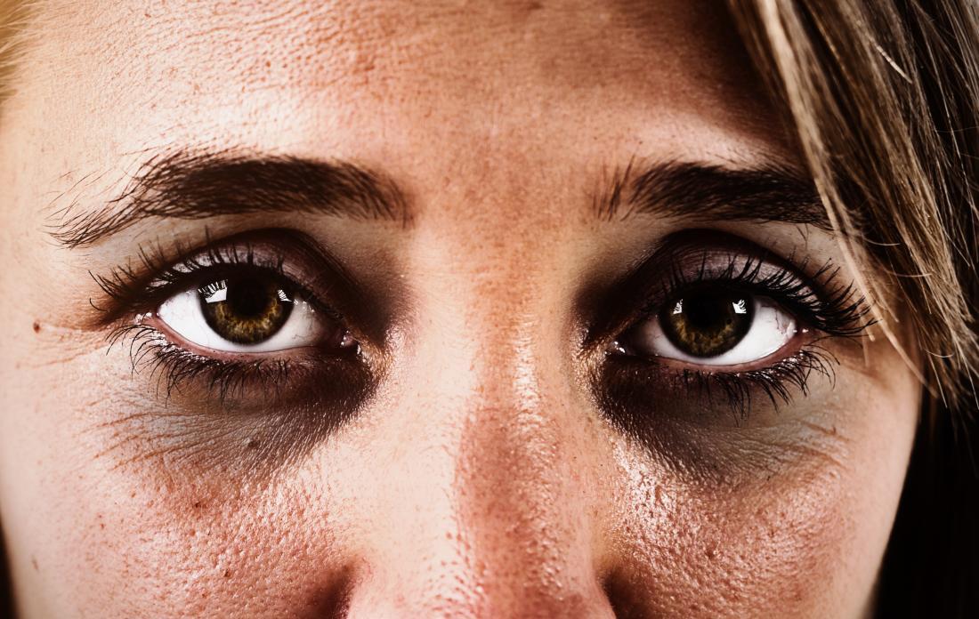 Descubre por qué aparecen las ojeras y bolsas que tanto te molestan