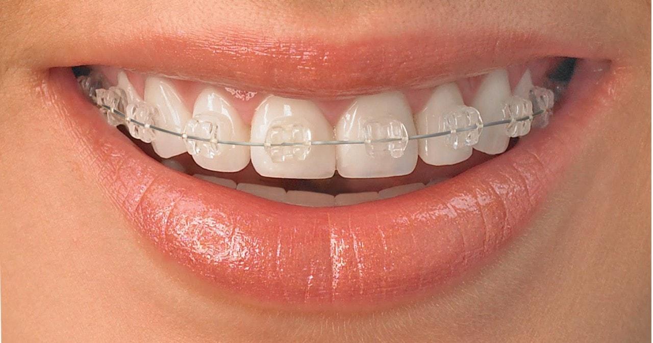 Qué esperar en tu primera visita y cómo prepararte para usar brackets discretos sin miedo