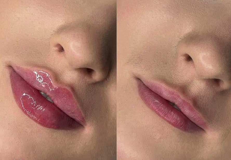 Ácido hialurónico en labios y surcos cómo te ayuda en hidratación, definición y soporte
