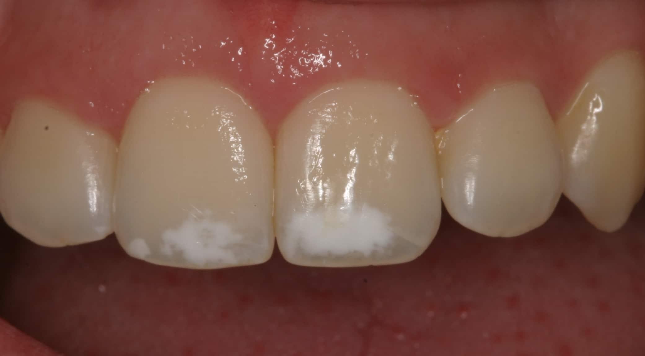 Descubre qué son realmente las manchas blancas y por qué aparecen en tus dientes