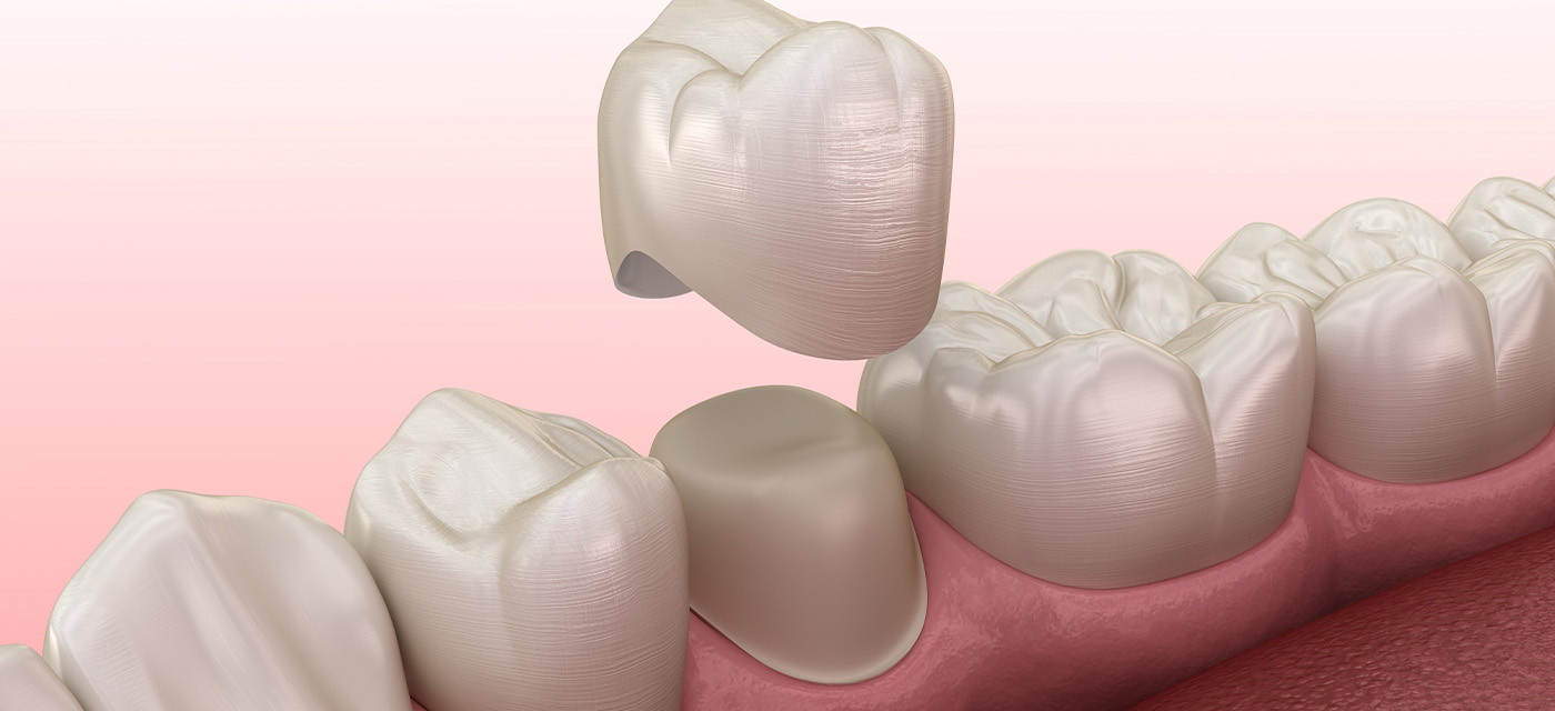 Zirconio vs Porcelana