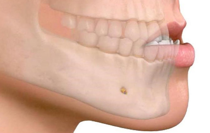 Marcación Mandibular