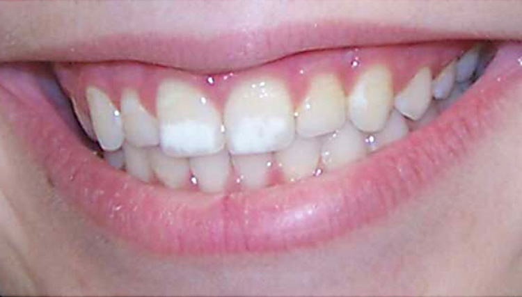 Manchas Blancas en los dientes