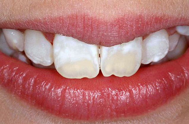 Manchas Blancas en los dientes