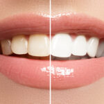Cómo Mantener tu Blanqueamiento Dental: Consejos para una Sonrisa Blanca por Más Tiempo