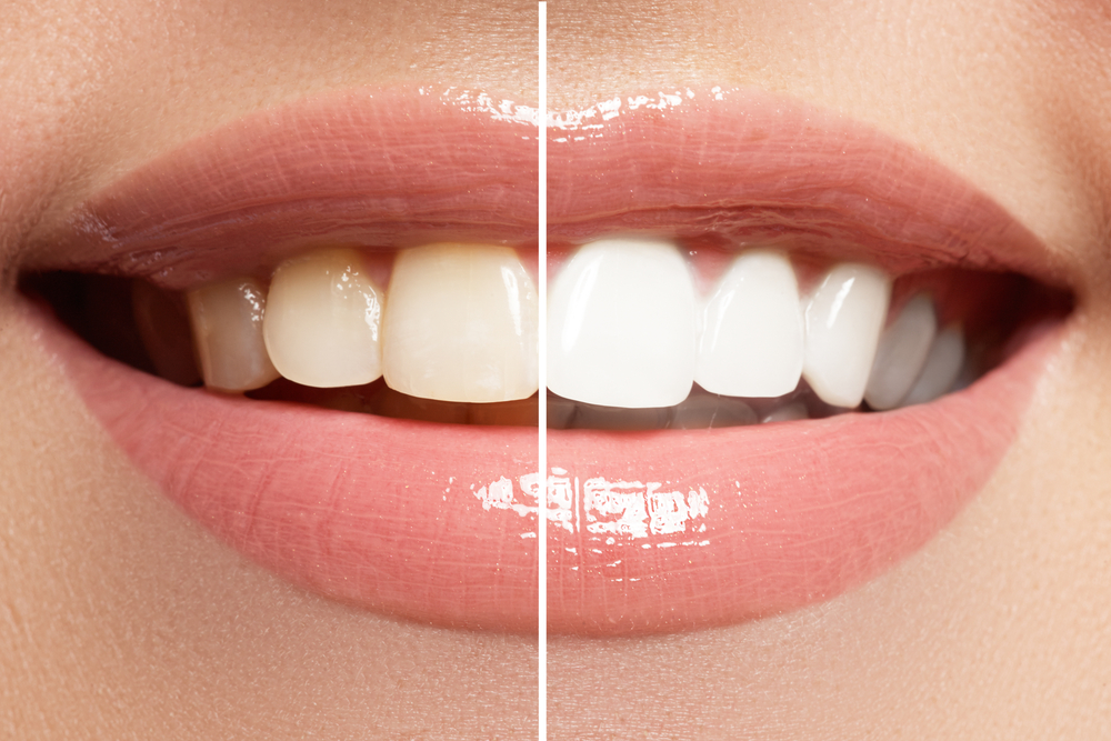 Cómo Mantener tu Blanqueamiento Dental: Consejos para una Sonrisa Blanca por Más Tiempo