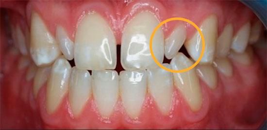 Dientes Conoides y Microdoncia
